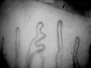 頸椎病甲襞微循環(huán)改變的臨床觀察